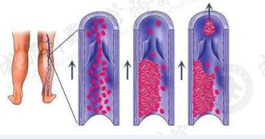 静脉血栓.jpg