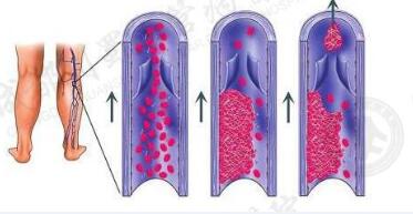 静脉血栓.jpg